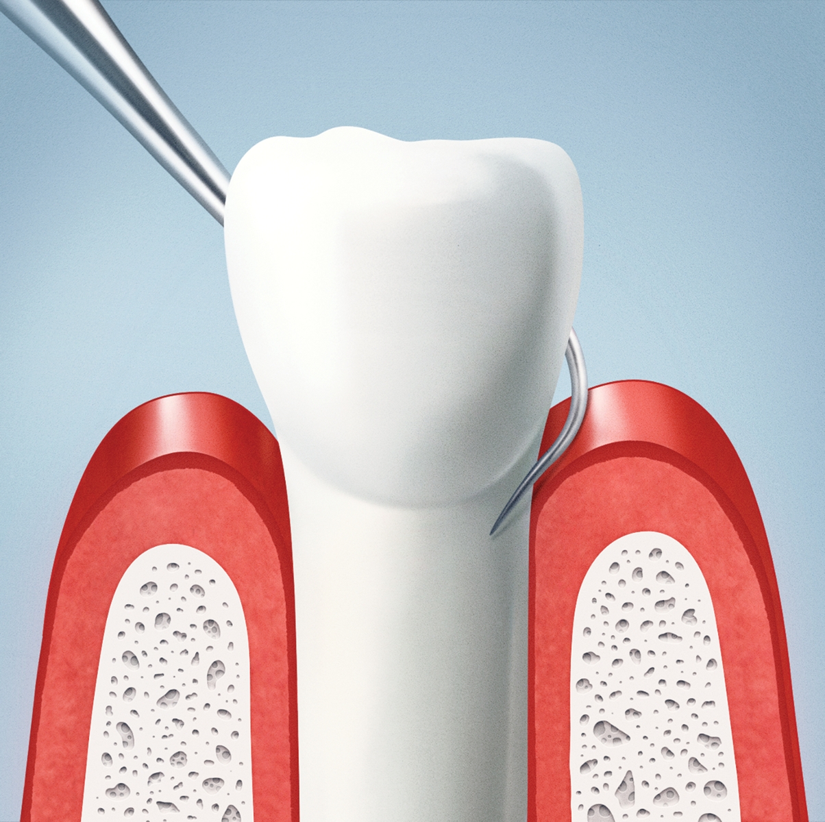 tooth being removed from rocket with dental tool 