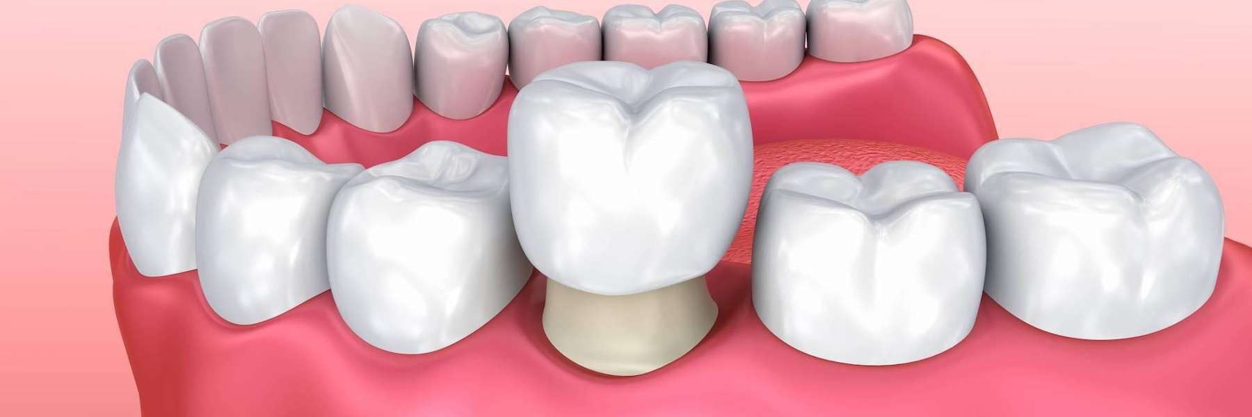 Image of a dental crown going on a tooth, mt pleasant, sc