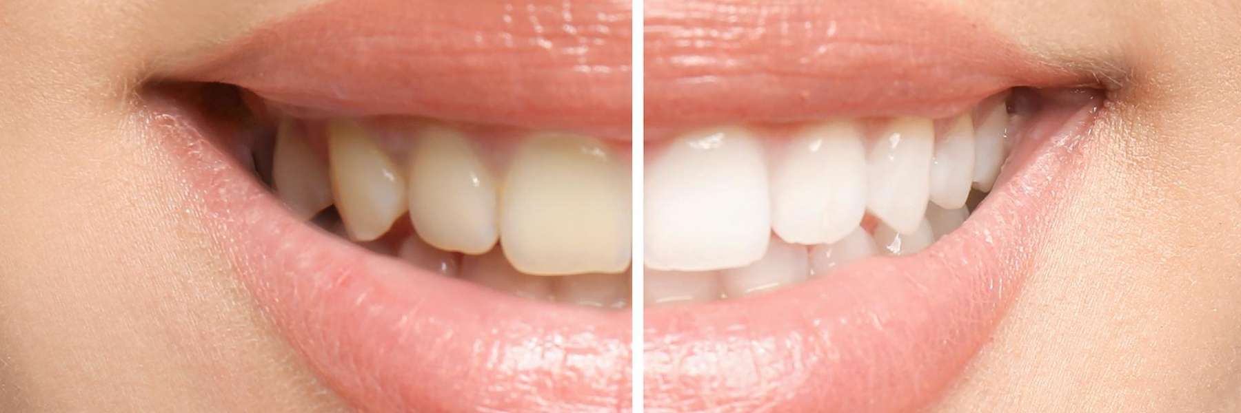 teeth whitening results in mt pleasant