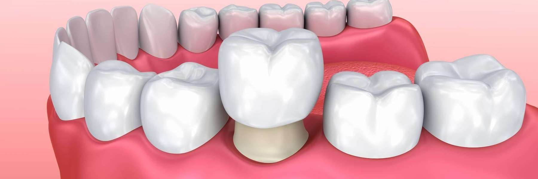Molar dental crown in Mt Pleasant