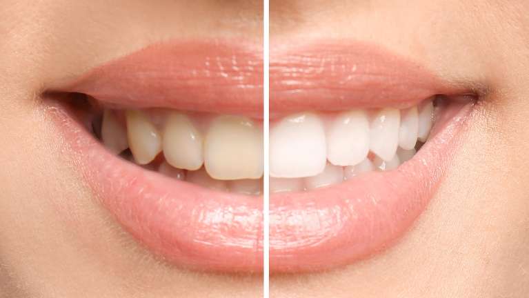 teeth whitening mt pleasant