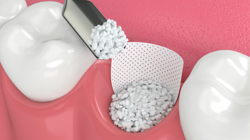 3D dental illustration showing bone graft material placed in a tooth socket with a membrane barrier