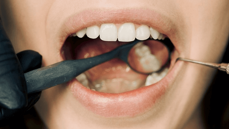 tooth extraction process mt pleasant