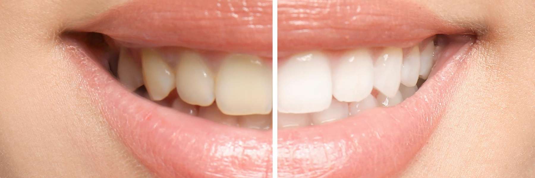 teeth whitening mt pleasant sc