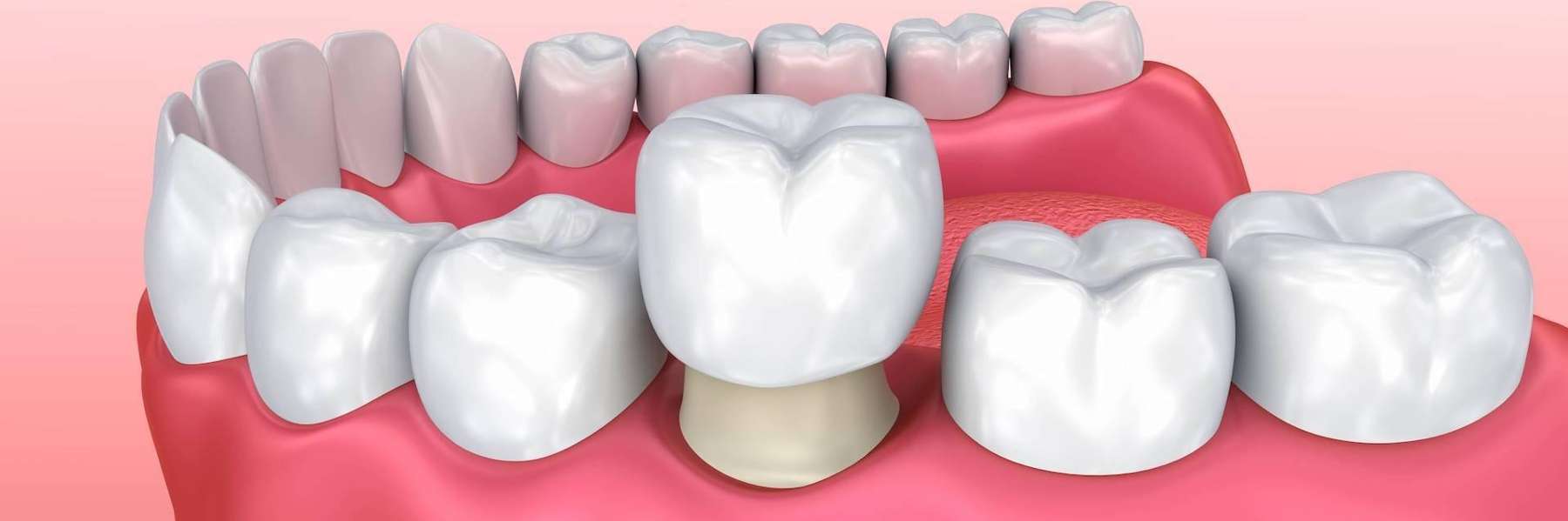 traditional dental veneers in Mt Pleasant SC
