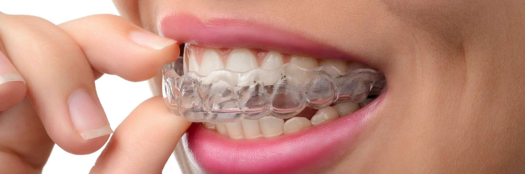 Person using a mouthguard for bruxism 