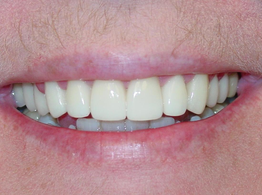 Patient's teeth after restorative dental procedure in Charleston