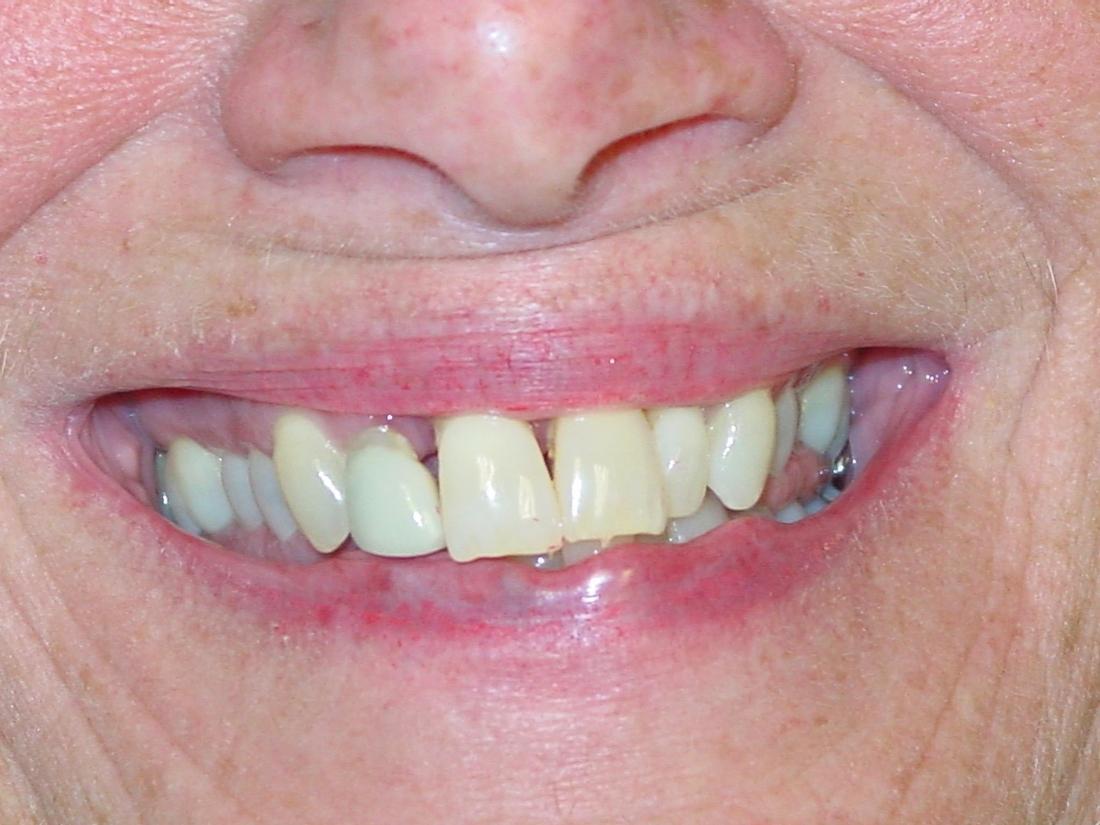 Close up of discolored and misaligned teeth at Mt Pleasant prosthodontist