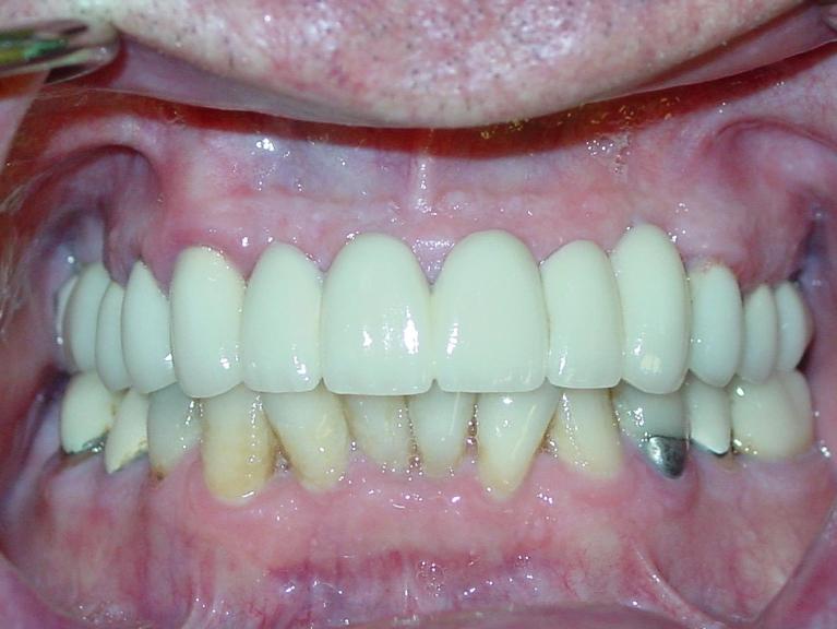 Patients teeth after restorative dentistry in Mt Pleasant, SC