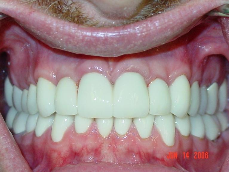 Patients teeth after restorative dental near me Charleston, SC