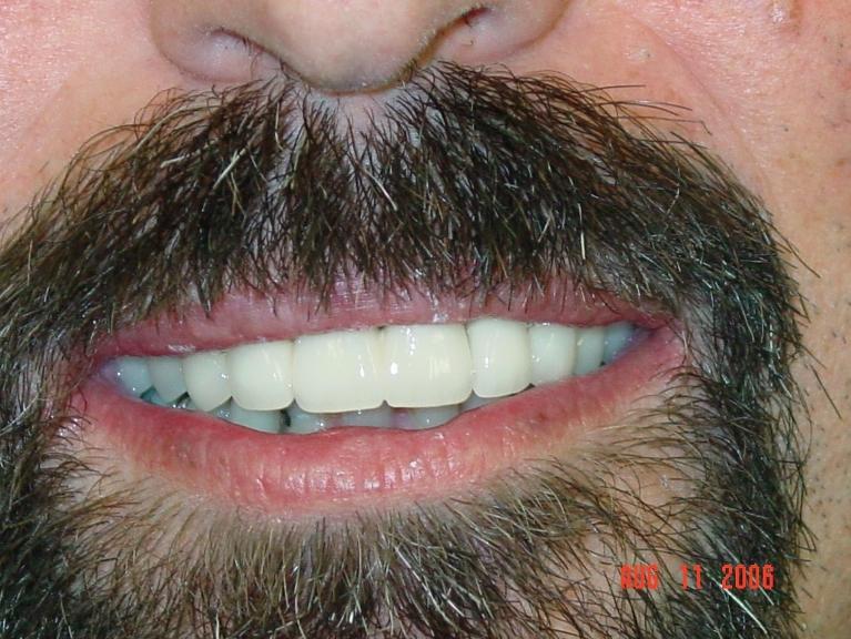 Patient's teeth after cosmetic dentistry in Mt Pleasant, SC