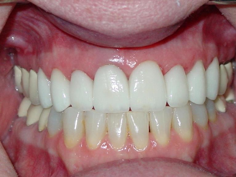 Patients teeth after restorative dental procedure in Charleston, SC