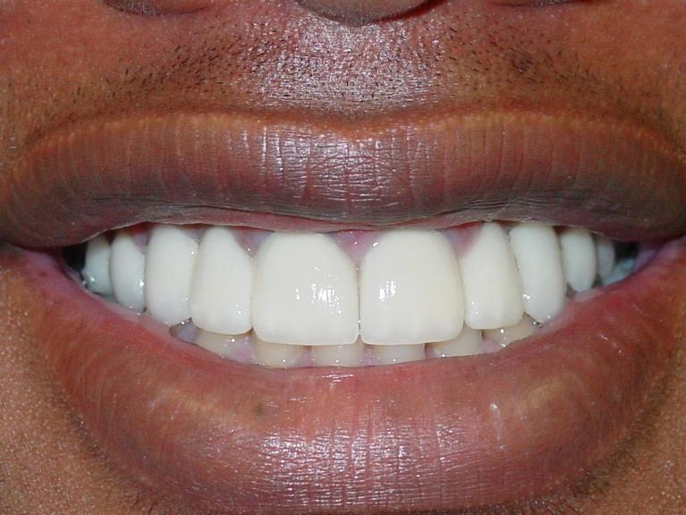 Patient's teeth after cosmetic dentistry in Mt Pleasant, SC
