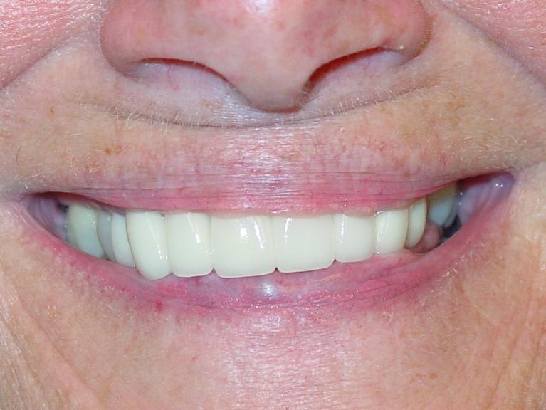 Teeth after cosmetic and restorative dentistry in Mt Pleasant, SC
