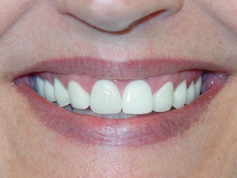 Patients teeth after restorative dental in Charleston, SC