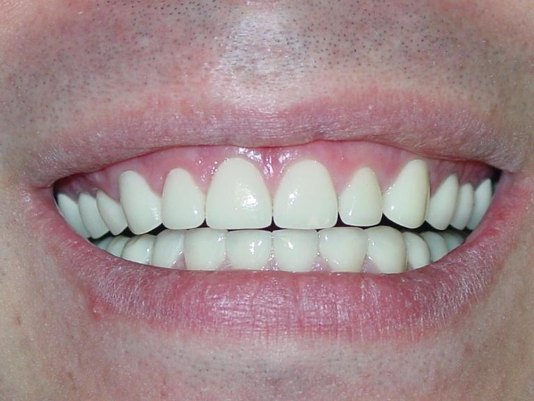 Patient's smile after cosmetic dental procedure in Mt Pleasant, SC