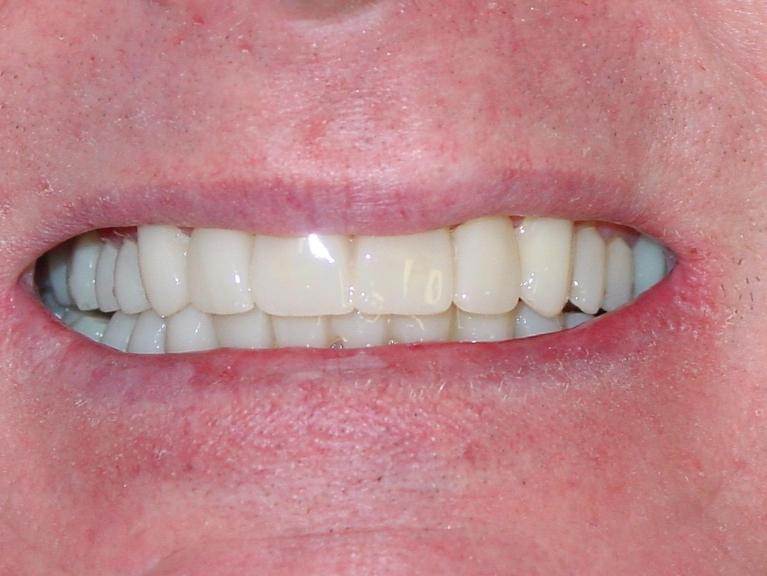 Patients teeth after restorative dental procedure in Mount Pleasant