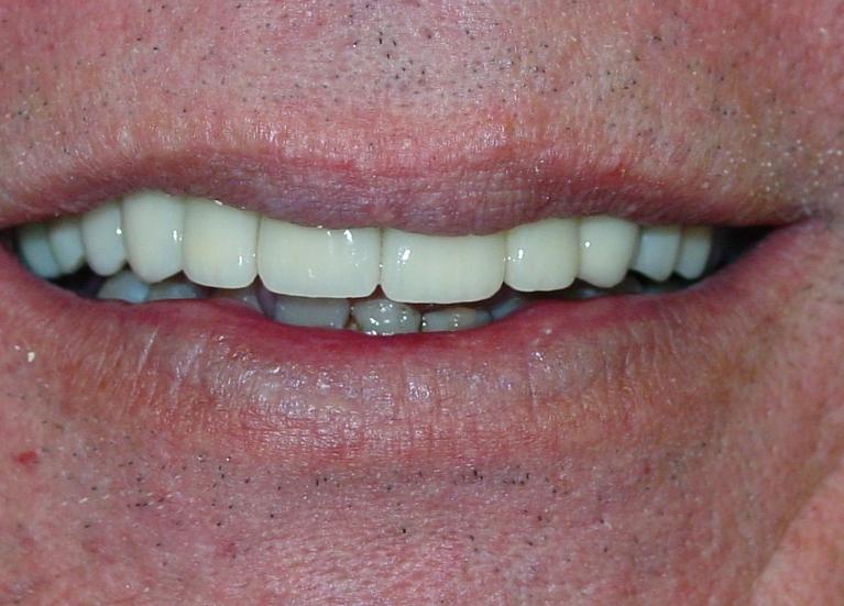 Patients teeth after procedure by dentist in Mount Pleasant, SC