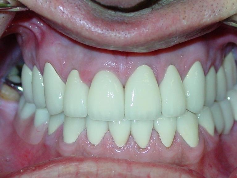 Patient's teeth after restorative dentistry in Mount Pleasant