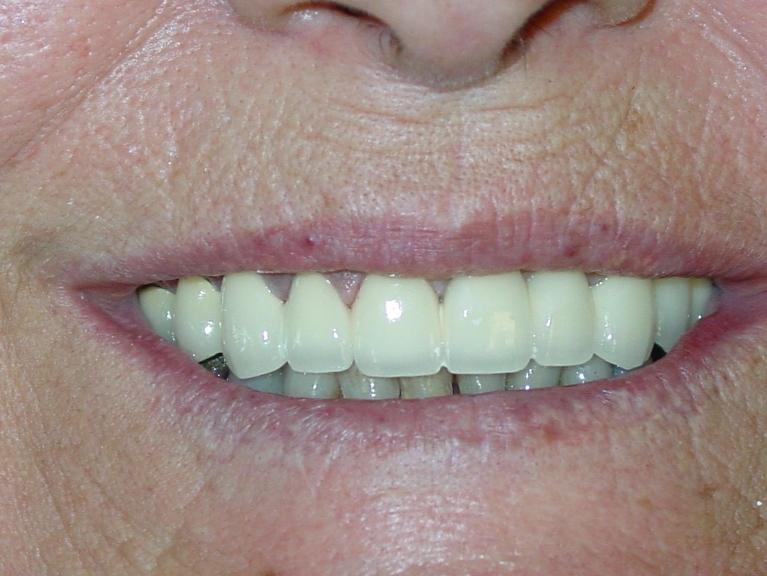 Teeth after restorative dental at dentist near me Charleston, SC