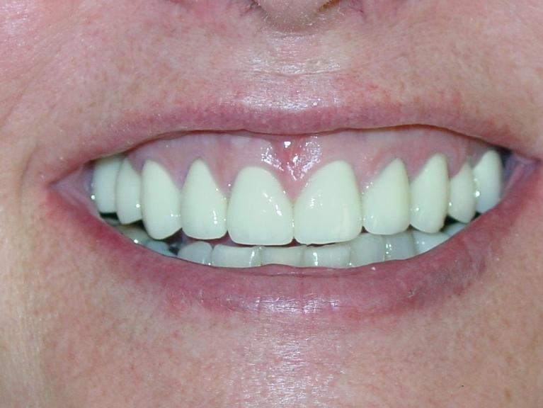 Patients teeth after restorative dentistry in Mount Pleasant, SC