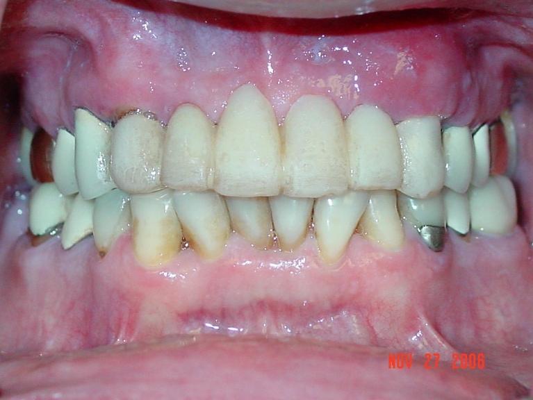 Patients teeth before restorative dental in Mt Pleasant, SC