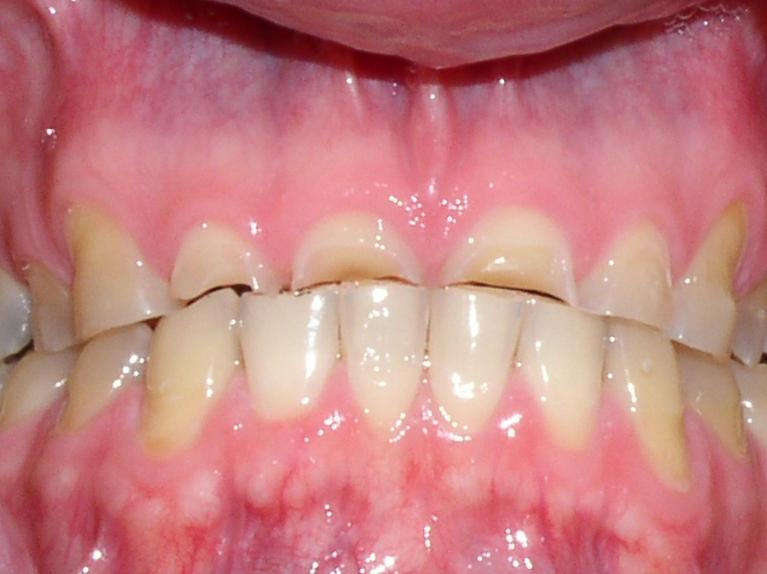Close up of severely worn down teeth at prosthodontist in Mt Pleasant, SC