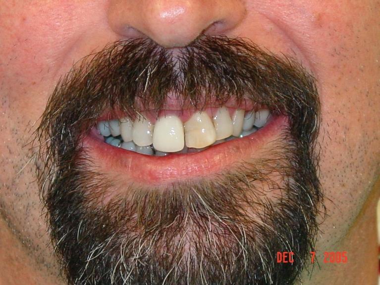 Patient's smile with misaligned and discolored teeth at dentist in Mt Pleasant, SC