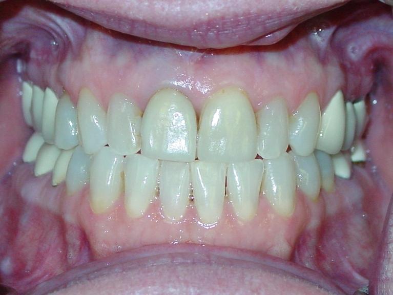 Patients teeth before restorative dental procedure in Charleston, SC