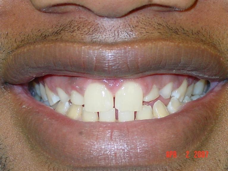 Patient's smile with misaligned teeth at dentist in Mt Pleasant, SC