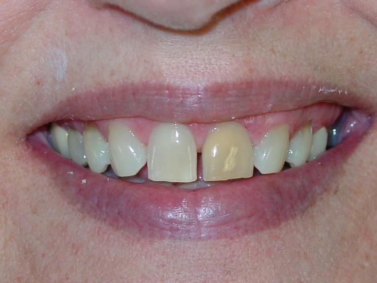 Front teeth with gap and discoloration at prosthodontist in Mt Pleasant, SC