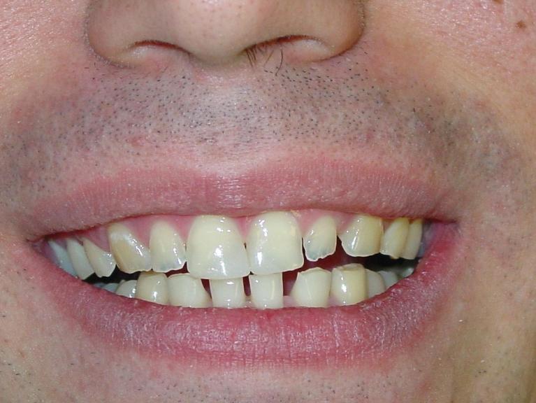 Patient smiling with misaligned and yellow teeth at cosmetic dentist in Mt Pleasant, SC