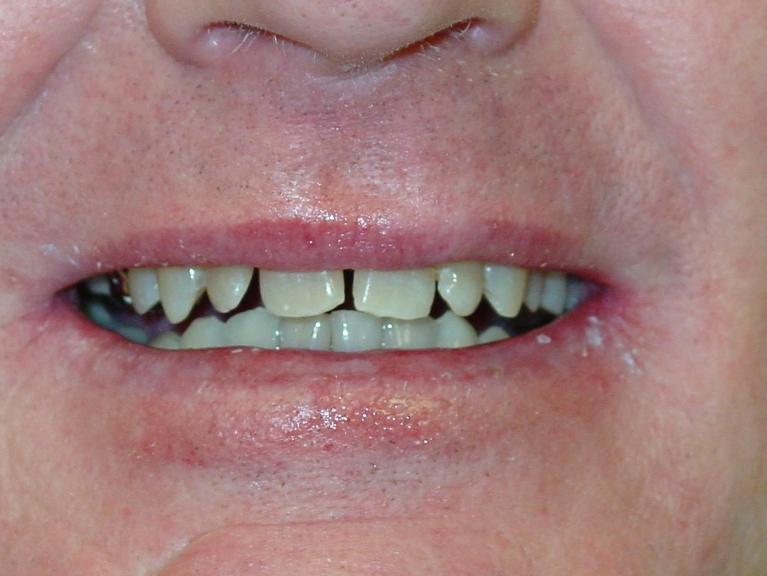 Dental patient with gaps in teeth at prosthodontist in Mt Pleasant, SC