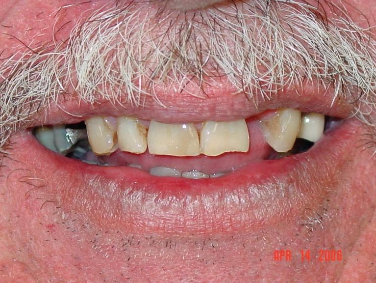 Patient with yellow and misaligned teeth at dentist in Mount Pleasant