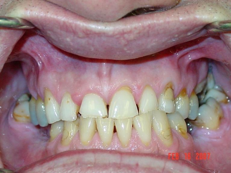 Teeth with severe tooth decay at dentist in Mount Pleasant