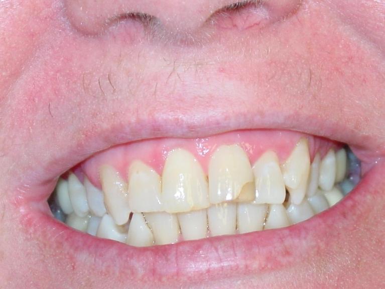 Patient with discolored and chipped teeth at prosthodontist in Charleston, SC
