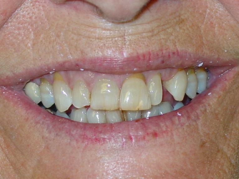 Patient smile with discolored and decayed teeth at dentist near me