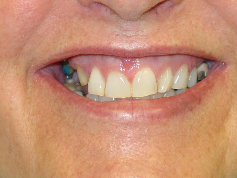 Patient with missing teeth at prosthodontist in Mount Pleasant